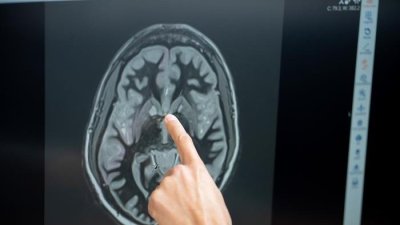 Logran medir la actividad cerebral de una paciente tratada con un fármaco antiobesidad