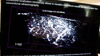 Tecnología pionera llega a Chile para estudiar lesiones cerebrales y caracterizar tumores cancerígenos