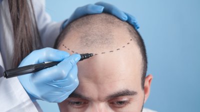 La tendencia que crece en Chile: En qué consisten los trasplantes de pelo que son furor en las redes sociales