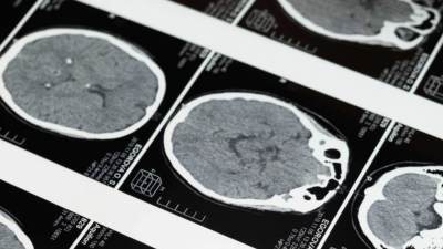 Revolución en neuroimagen: Científicos revelan método que podría ayudar a detectar el Alzheimer en etapas tempranas